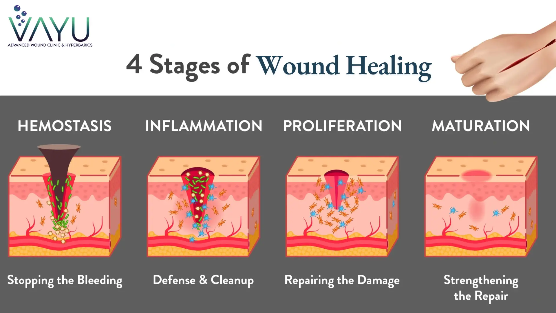 4 Wound Healing Stages